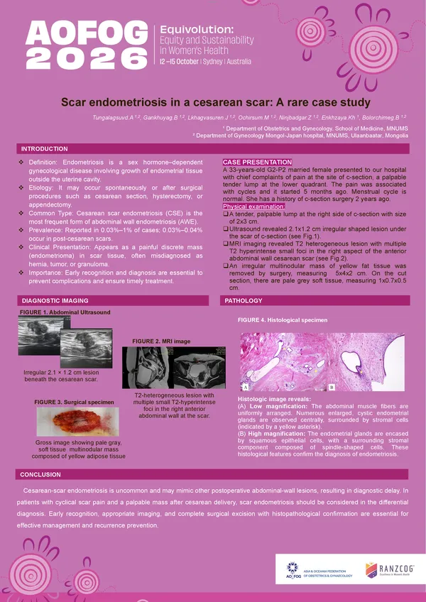 Scar endometriosis in a cesarean scar: a rare case study