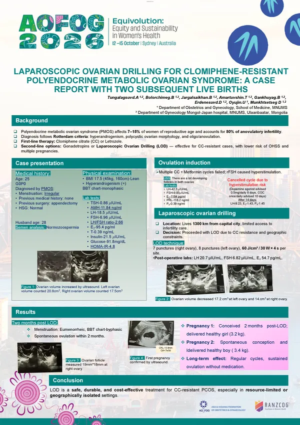 Laparoscopic Ovarian Drilling for Clomiphene-resistant Polyendocrine metabolic ovary syndrome: A Case Report with two subsequent live births