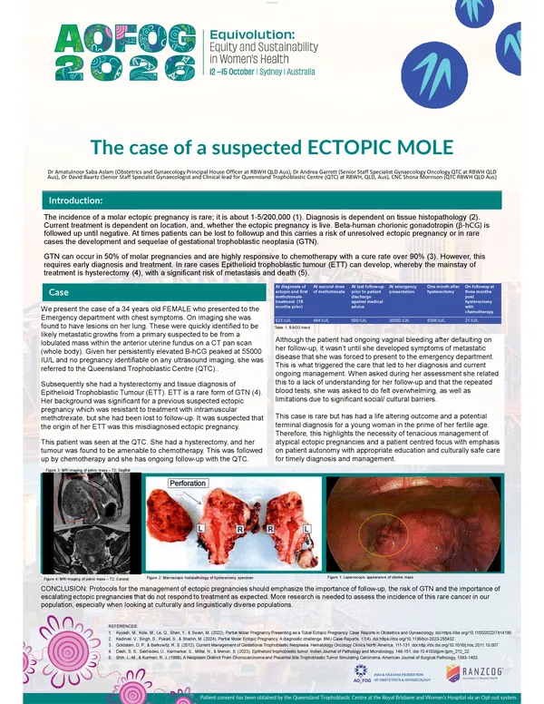 The case of a suspected Ectopic Mole