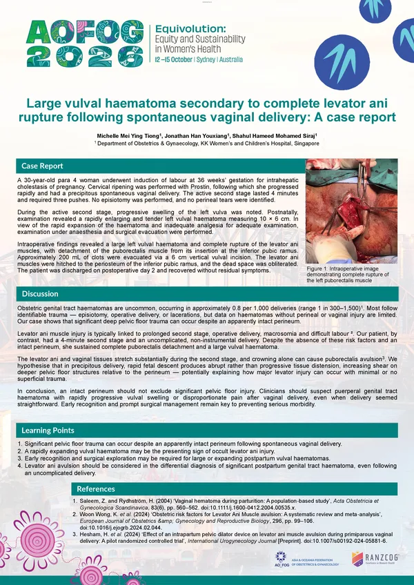 Large vulval haematoma secondary to complete levator ani rupture following spontaneous vaginal delivery: A case report