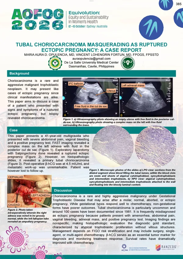 Tubal Choriocarcinoma Masquerading as Ruptured Ectopic Pregnancy: A Case Report
