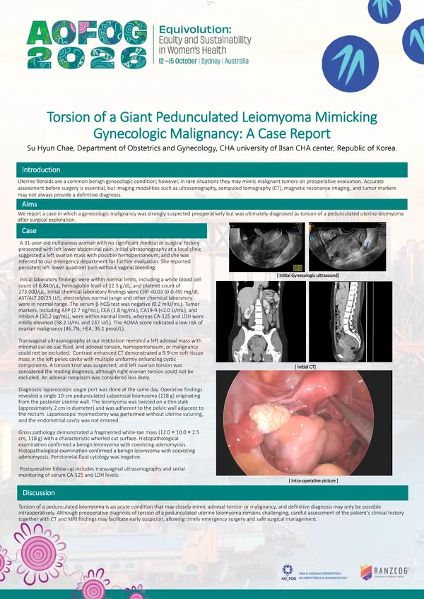 Torsion of a Giant Pedunculated Leiomyoma Mimicking Gynecologic Malignancy: A Case Report