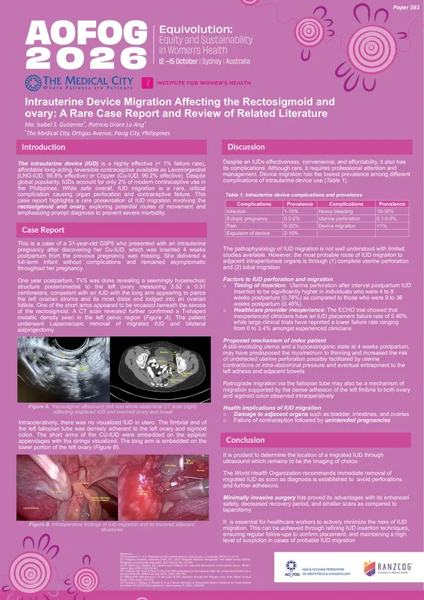 Intrauterine Device Migration Affecting the Rectosigmoid and Ovary: A Rare Case Report and Review of Literature