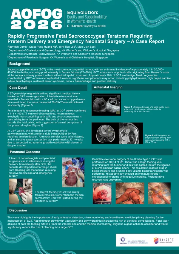 Antenatal Sacrococcygeal Teratoma Complicated by Polyhydramnios and Neonatal Haemorrhagic Shock: A Case Report