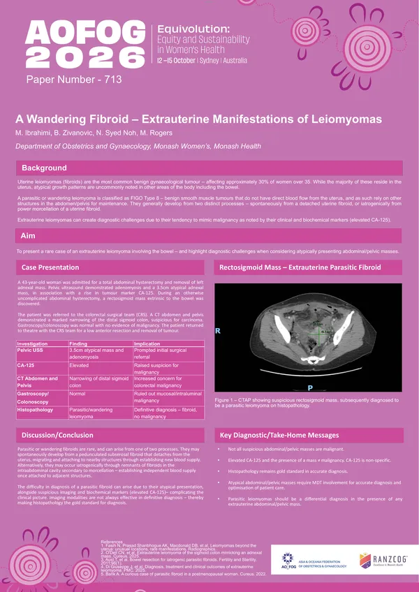 The Wandering Fibroid – Extrauterine Manifestations of Leiomyomas