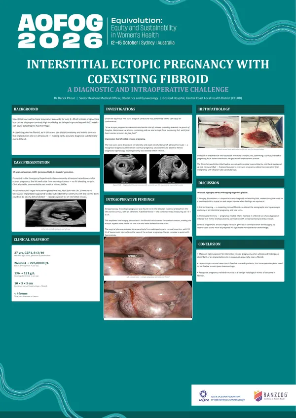 Interstitial Ectopic Pregnancy with Coexisting Fibroid: A Diagnostic and Intraoperative Challenge