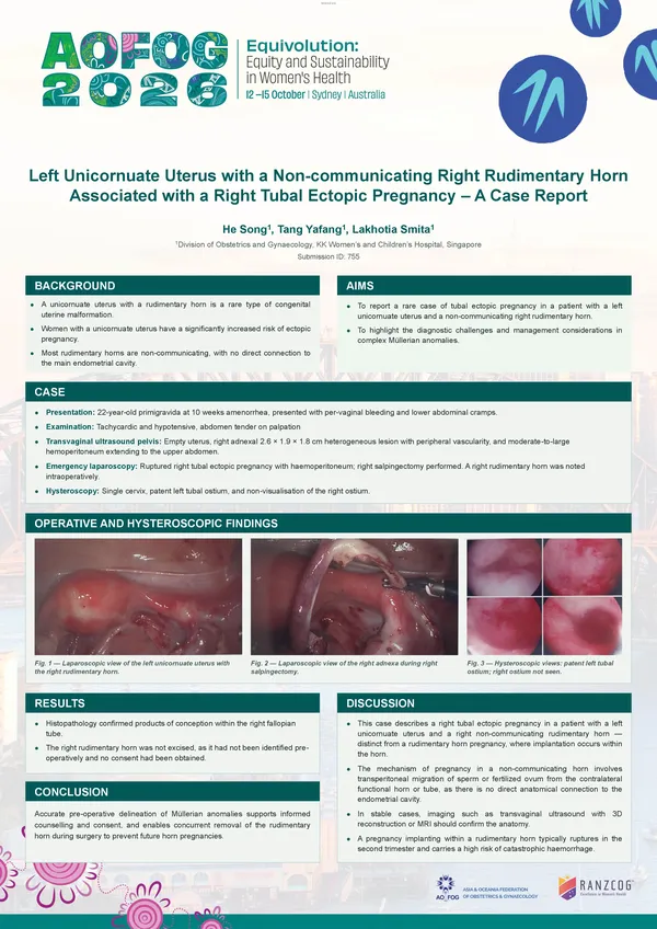 Left Unicornuate Uterus with Non-communicating Right Rudimentary Horn Associated with Right Ectopic Pregnancy in the Right Fallopian Tube – a Case Report