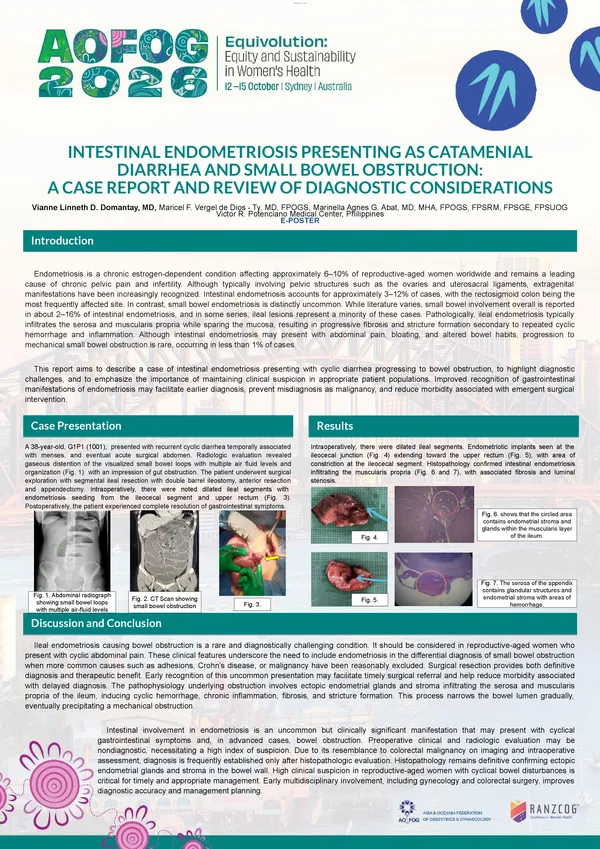 Intestinal Endometriosis Presenting as Catamenial Diarrhea and Small Bowel Obstruction: A Case Report and Review of Diagnostic Considerations