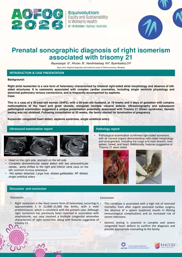 Prenatal sonographic diagnosis of Right isomerism associated with trisomy 21