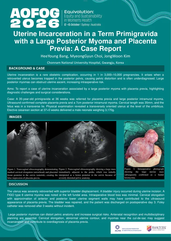 Uterine Incarceration in a Term Primigravida with a Large Posterior Myoma and Placenta Previa: A Case Report