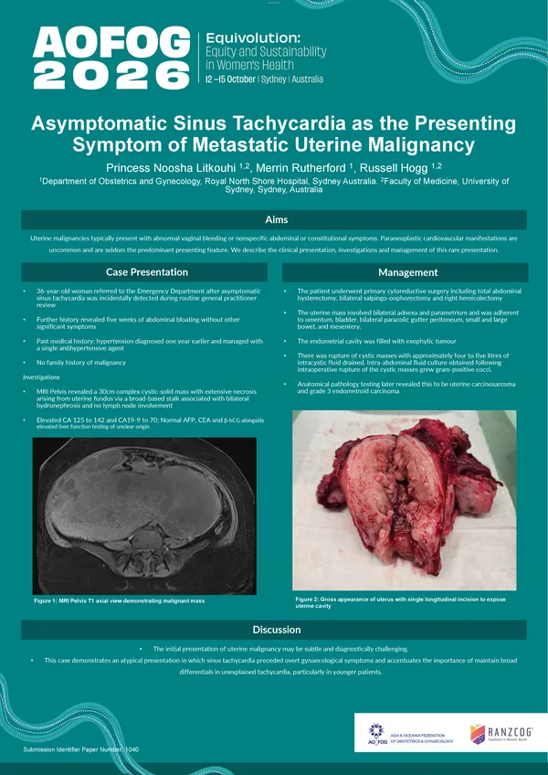 Asymptomatic Sinus Tachycardia as the Presenting Symptom of Metastatic Uterine Malignancy
